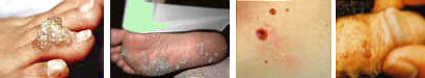 warts on hand, foot, moles, skin tag